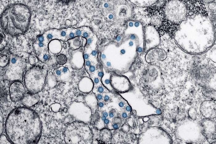 Transmission electron microscopic image of an isolate from the first U.S. case of COVID-19, formerly known as 2019-nCoV. The spherical viral particles, colorized blue, contain cross-sections through the viral genome, seen as black dots. The recent outbreak of the virus has lead to the Algonquin community taking precautions to attempt to limit its spread.